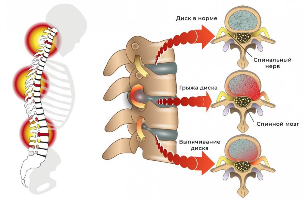 Грыжа диска - это распространенное состояние позвоночника, которое возникает, когда мягкая ткань внутри межпозвоночного диска выдавливается за его пределы и давит на нервные окончания.
